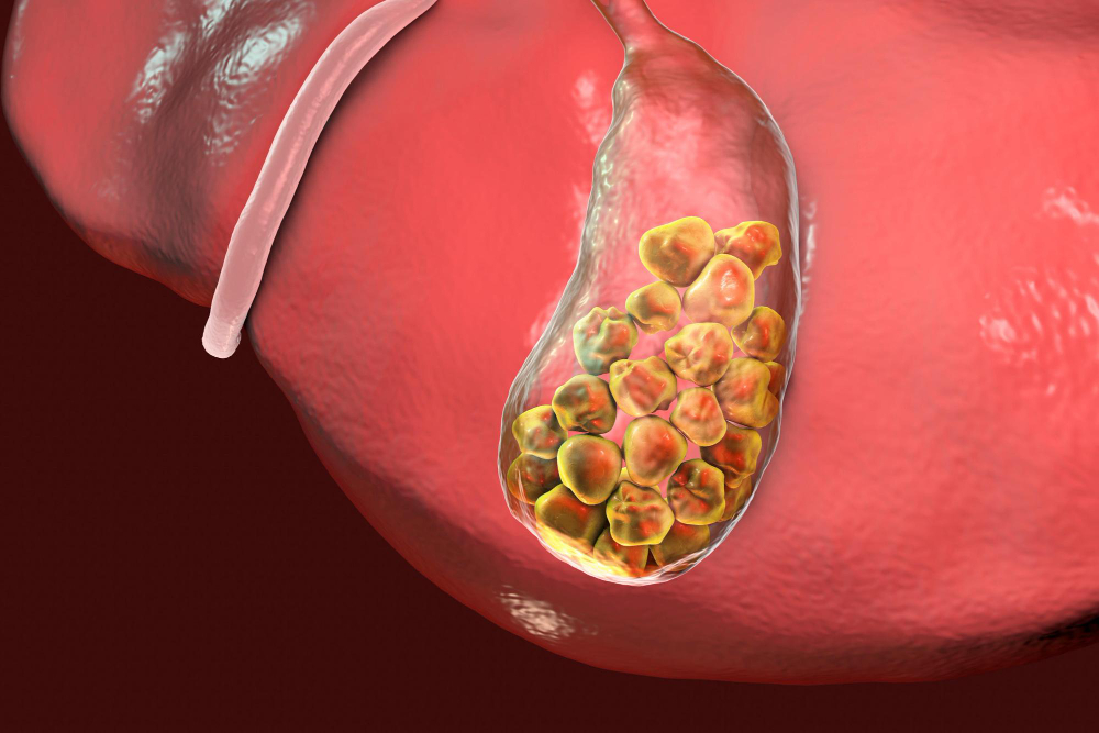 Gallbladder stones treatment in Hanamkonda
