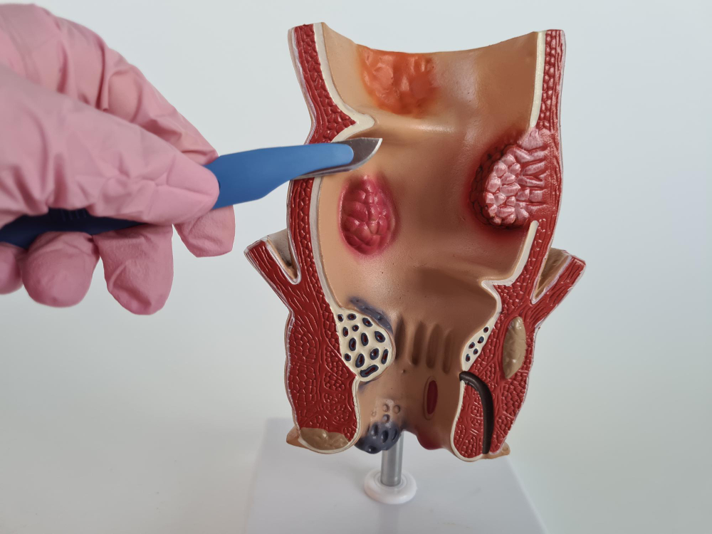 Laser Fistula Treatment in Hanamkonda & Warangal